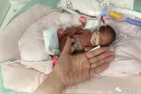 山东体重最轻新生儿迎百天，出生时还没手掌大 网友：健康长大，小宝贝图片