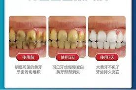 Qing调查｜“7天就能黄牙变白牙”网红美白牙贴靠不靠谱？图片