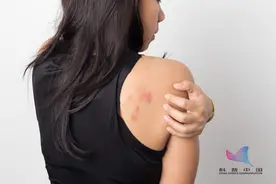 身上突然出现小红点，别不当回事！这种可能是肝脏在求救图片