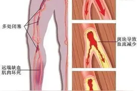 腿部出现这种症状，有可能是下肢“中风”图片