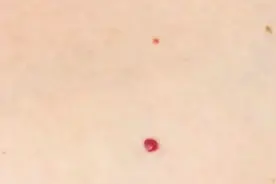 皮肤偶尔瘙痒、出现红点很多人不当回事，有可能是这些疾病的征兆图片
