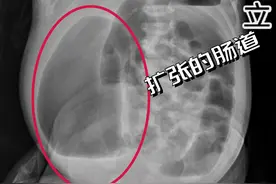 宝宝肚子大要小心！出生6天女娃肚子胀得像皮球，竟是出生没有肛门图片