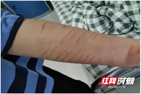 心理专家支招应对青少年非自杀性自伤行为图片