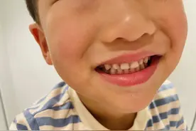 乳牙蛀了之后一定要补吗？我带孩子补牙的经历图片