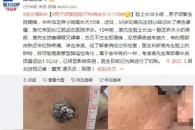 男子频繁抠痣不料病变长大15倍，有时局部皮肤还会红肿疼痛、渗血渗液图片