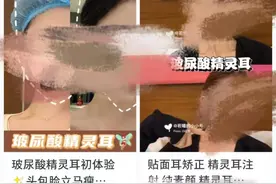 网红鼓吹“精灵耳”等自残式整容，容貌内卷何以至此图片