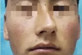 21岁男子从小趴着睡鼻子睡歪图片