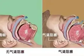 男子睡一觉“断气”400多次！医生：这可能要人命图片