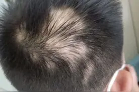 高考临近，母子连心：杭州一考生和妈妈同时患上斑秃图片