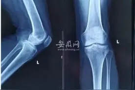 膝关节手术不再“一刀切”！单髁置换让骨性关节炎患者保留“膝”望图片