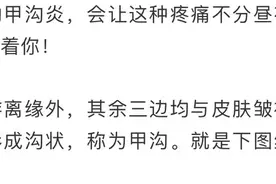 剪指甲也有讲究！方法不对，当心这种病痛缠上你图片