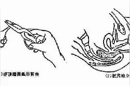 开塞露是最安全的通便药吗？图片