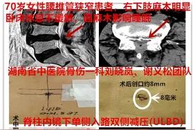 间歇性跛行咋回事？小微创解决腰椎大问题图片