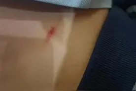 只因没做作业，贵阳一九岁女孩被老师砸伤？！家长反映：已经不是第一次了图片