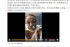 歌手徐真真全身二级深度烧伤 曾与吴亦凡、马东、蔡康永录制节目图片