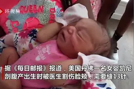 美国一女婴出生时被医生用手术刀割伤脸颊 需要缝13针