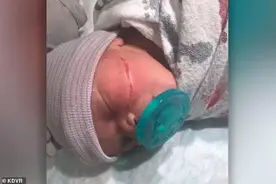揪心！剖腹产手术致女婴毁容 严重划伤已缝合13针，未来还需整形图片