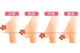 有人忙着花钱隆胸，有人却巴不得胸小一点……图片