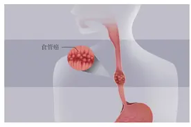 出现前胸或后背隐痛，别忽视了食管的问题图片