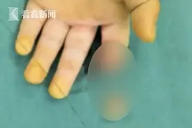 家长一时大意 两岁男童拿刀玩切掉自己食指图片