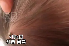 出生4天的婴儿头部有个“小球”，原来是蜱虫钻入！爸爸后悔没关车窗图片