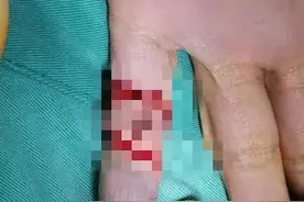 可怕！厦门一男子在海里游泳，手指肌腱、神经被鱼咬断图片