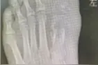 一根小铁钉“蛀”空大脚趾图片
