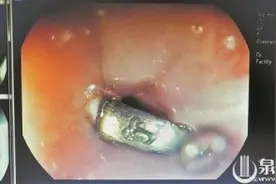 泉州：儿童误吞异物 一枚硬币在孩子食道卡了一星期图片