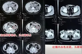 大一男生每天4公里跑步排肾结石，突发剧烈腰痛发现情况不妙图片