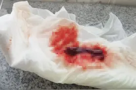 5岁男孩鼻血不止，甚至吐出血块，竟是因为止血方法错误，你也错了吗？图片