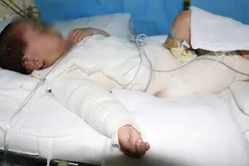 妈妈不哭！2岁女娃意外烧伤，母亲欲割皮救女反被安慰图片
