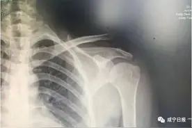 这种新技术，为你减轻关节脱位的痛图片