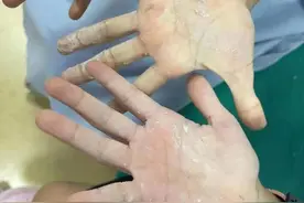 南宁两个孩子遭恶作剧，手掌被502胶牢牢粘住！医生一个办法成功解救图片