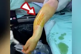 掰手腕不能用力过猛！上海16岁男生和同学掰手腕粉碎性骨折视频封面