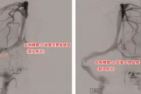 莫名头痛伴视力模糊病因竟是静脉窦狭窄 支架置入“天堑变通途”图片