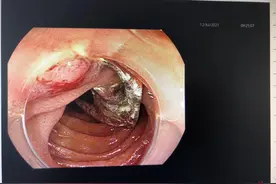 男子吃橘子时不慎吞入牙套，一个多月后腹部疼痛 医生：进食莫匆忙图片