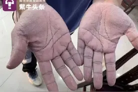 心疼！这是南京95后医生的手图片