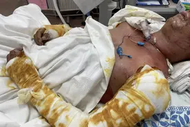 新买的电单车电池清晨爆燃，外卖小哥胸部以上严重烧伤图片