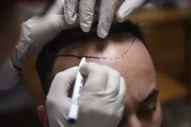 “脱发经济”带火毛发产业，连锁机构高获客成本下持续扩张图片