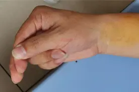 男朋友与路人吵架，一旁的她居然“中毒”了？手脚拘挛成“鸡爪”图片