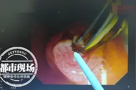 男子体内发现很多寄生虫，医生：和饮食习惯有关图片