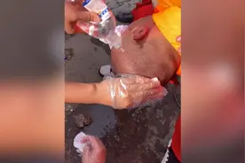 心疼！小伙剃光头赶赴河南救援头皮被晒伤 上药时调侃“撒点孜然”图片