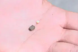 外卖吃出石子，石子硌掉蛀牙，镶牙需要1800，这钱该谁拿？图片
