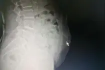 惊险！广州阿婆自行针灸，针断腹中！医生：擅自针灸有风险图片