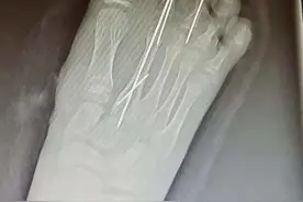 爸爸抽根烟的功夫，11岁女儿少了两脚趾，一月10多例！医生这样提醒图片