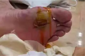 心疼！谌龙的脚上从小组赛就有小泡 打到最后已成了大血泡图片