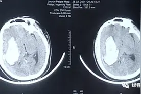 险！上海医生云南绿春成功救治大量脑出血患者，对口支援填补当地急诊技术空白图片