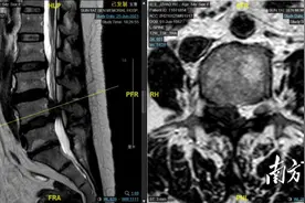 腰椎间盘突出，手术切口仅8毫米，是什么体验？图片