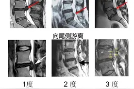 8毫米小切口下“修”腰椎，巨大腰椎间盘突出亦可微创手术图片