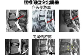 8毫米小切口下“修”腰椎，巨大腰椎间盘突出亦可微创手术图片